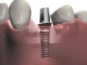 стоимость зубных имплантов