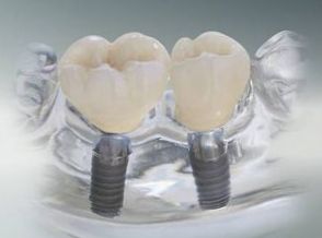 импланты зубов в стоматологии в Нижнем Новгороде
