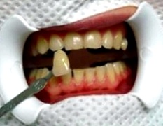 Отбеливание зубов «Zoom-3»