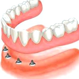 Покрывные зубные протезы 