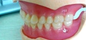 Покрывные зубные протезы 