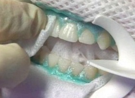 фотоотбеливание зубов