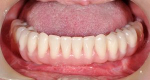 протезирование полости рта