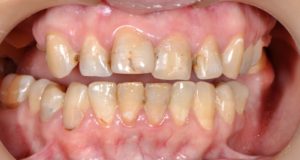ситуация до разомкнутые зубы